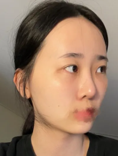 [目] コグマインヒョン - 目、輪郭、脂肪移植