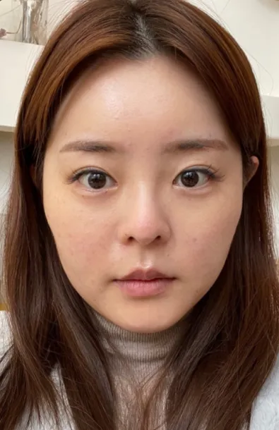 [目] ト끼야 - 目、鼻、輪郭、顔の脂肪吸引