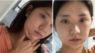 [輪郭手術] ティッシュ - 輪郭、鼻