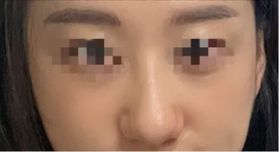 [鼻] ライニー - 鼻