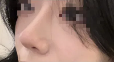 [鼻] ガラスの破片 - 鼻