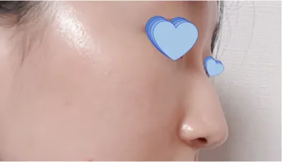 [鼻] ムシムシ魔女 - 鼻