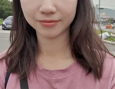 [プチ] ヒマワリssi - シュリンク、輪郭ボトックス