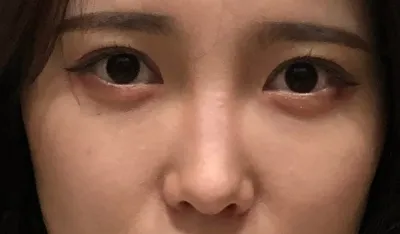 [鼻] 日差し - 鼻