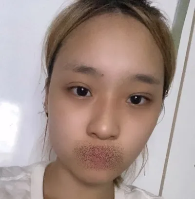 [輪郭手術] イクリプス - 目、鼻、輪郭