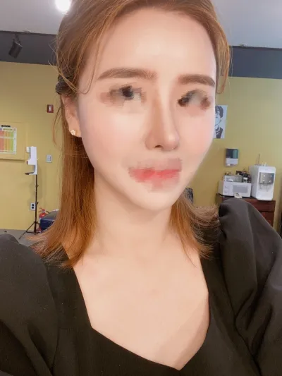 [アンチエイジング] 質問受け付けます - フルフェイス脂肪移植、鼻