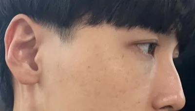 [輪郭手術] 2ヶ月目 - 目、鼻、輪郭