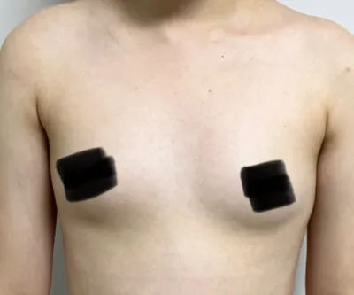 [豊胸] Motiva - 胸