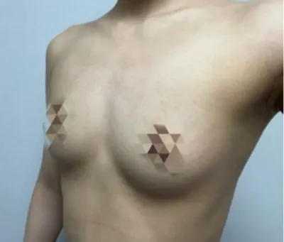 [豊胸] ふっくら - バスト