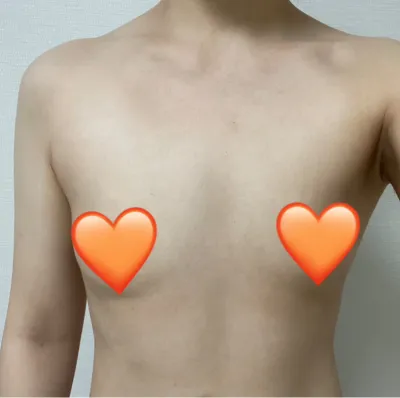 [豊胸] セントリー - 胸