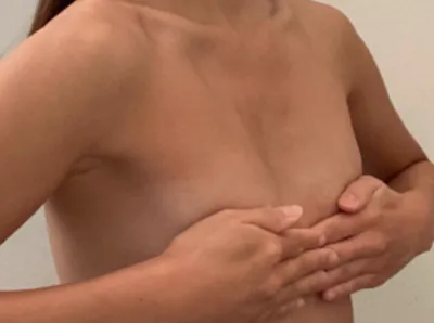 [豊胸] レモントゥリンキック - 胸