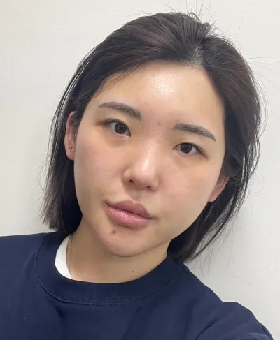 [目] 桃 - 非切開式目つき矯正(再手術)、目頭切開、目尻切開