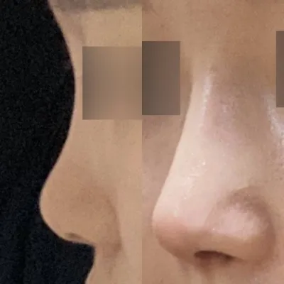 鼻の初手術をウィーバースで受けました