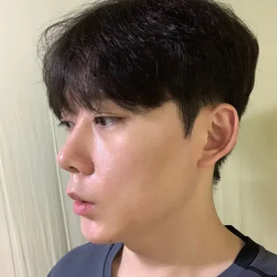 シム・ジョンファン院長に鼻の手術を受けてから2週間目です