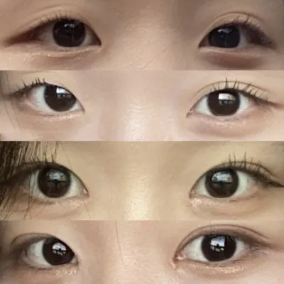 目の手術を受けました :)