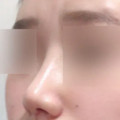 鼻の再手術をして2ヶ月になりました