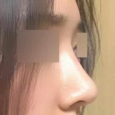 非対称、団子鼻矯正をしました