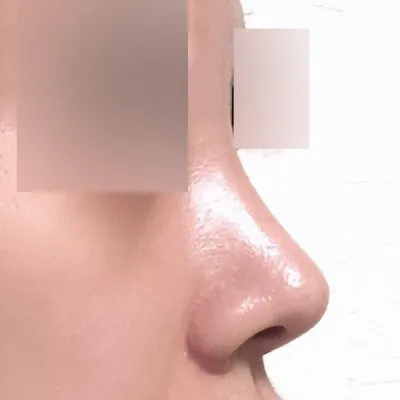 短くて団子鼻だった鼻がすっきりしました