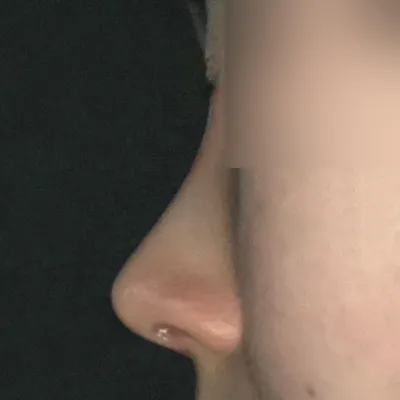 ソ・スンジョ院長に鼻の手術を受けて1ヶ月目です！