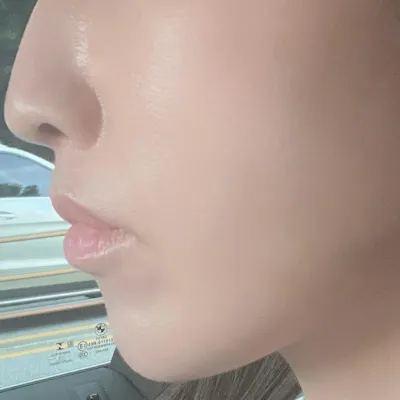 気になっていたほうれい線を改善しました！