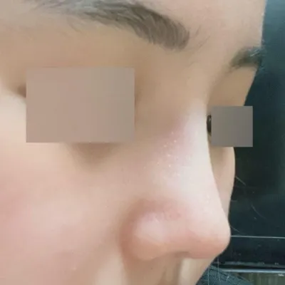 短い鼻＋機能鼻手術後2ヶ月です