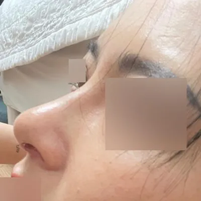 プロテーゼなしの鼻整形手術を受けました^^