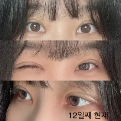 目の再手術、大満足のリアルレビュー