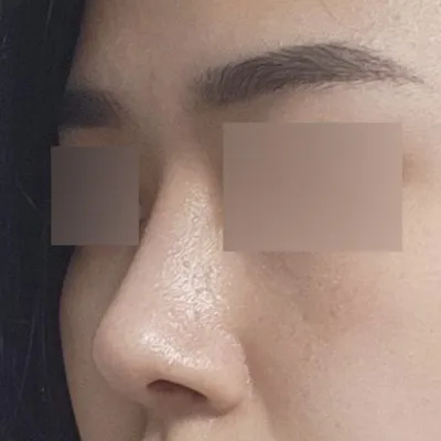 小鼻縮小手術から2ヶ月経ちました！