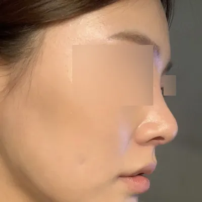 ヒアルロン酸注射とは比較にならない鼻整形手術後2ヶ月