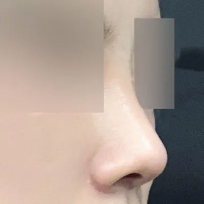 鼻の手術から1ヶ月経ちました！