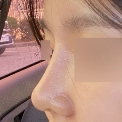 低い団子鼻の手術をして3ヶ月になりました