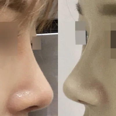 鼻の手術を受けてからもう3ヶ月経ちました