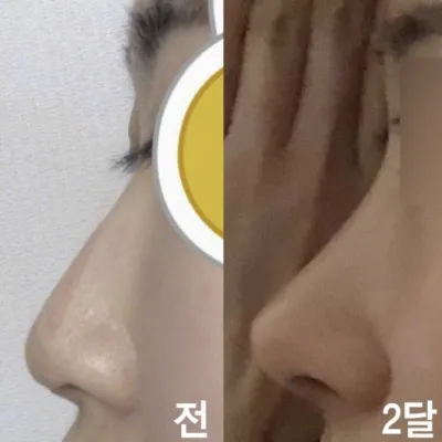 男らしいハンプとわし鼻を洗練された形に手術しました！