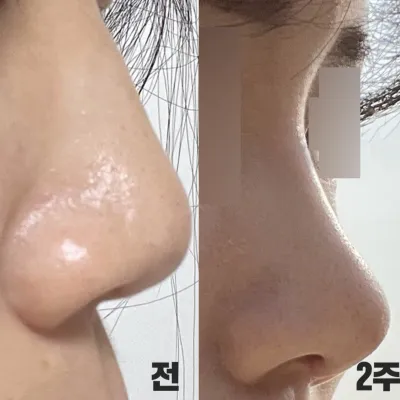 鼻の手術を受けてから1ヶ月になりました！