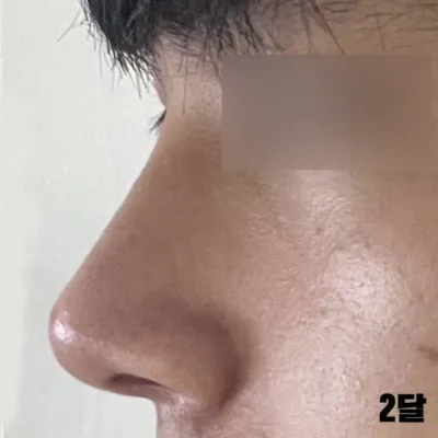 手術の際、小鼻縮小も一緒に行いましたが、満足しています。