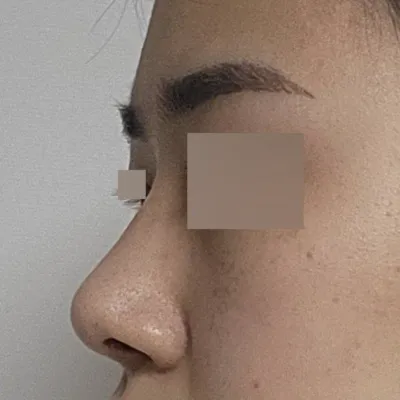 手術して3ヶ月になりました。