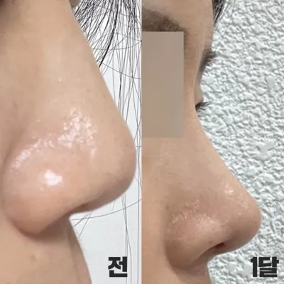 直線的な鼻の形で手術を受けて1ヶ月