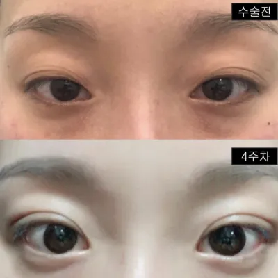 たるんだまぶたと二重のしわの悩みを解消しました