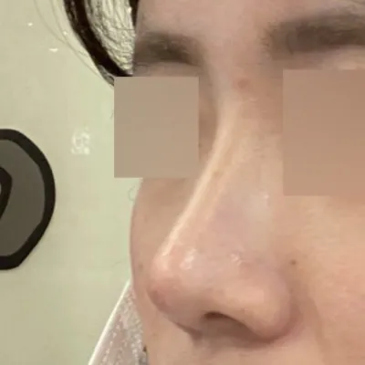 鼻の手術を受けてからもう2ヶ月になりました！