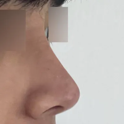 団子鼻の手術を受けてから3ヶ月になりました。