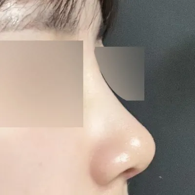 コンプレックスだった鼻がきれいになりました!