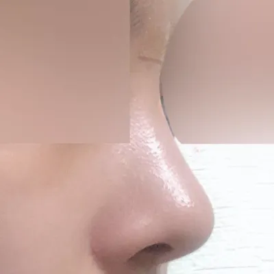 鼻の手術後3ヶ月目のレビュー