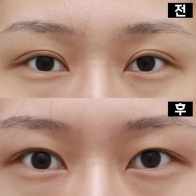 ソーセージ目再手術と目つき矯正を受けてきました!