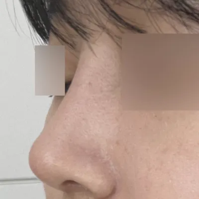 鼻の手術後1ヶ月、成功しました！