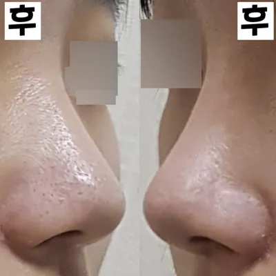 初めての鼻整形から2週間！