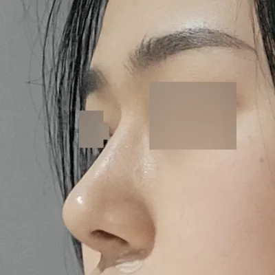 ウィバースで手術してから5ヶ月目です