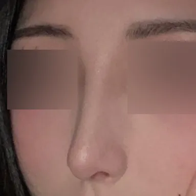 わし鼻でストレスを受けて思い切って手術しました！！