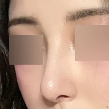 手術後1ヶ月です。