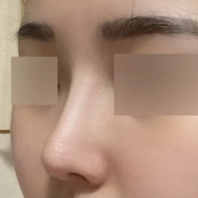 きれいに鼻炎手術をしてから6ヶ月になりました