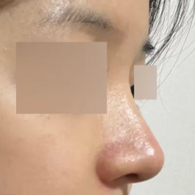 鼻の手術をしてからもう半年になりますね（笑）